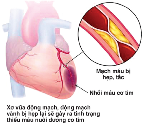 Chú ý khi sử dụng nitroglycerin